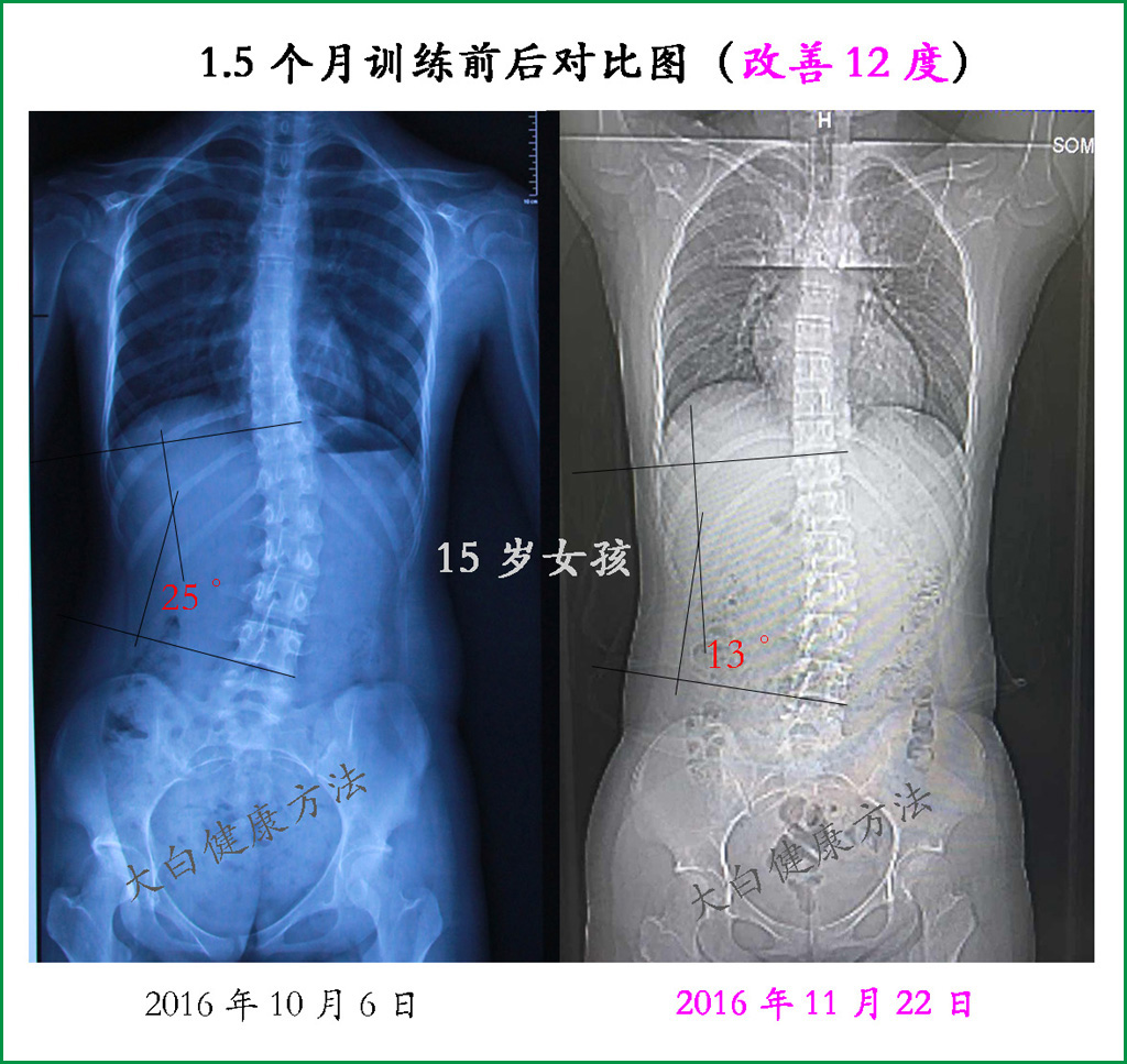 [2019下半年]大白脊柱侧弯训练报名,2天现场训练